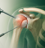 20250808_1210_Arthroscopy Precision Visualized_simple_compose_01k246gjfxeasagyy2asaybj9m 20250808_1210_Arthroscopy Precision Visualized_simple_compose_01k246gjfxeasagyy2asaybj9m